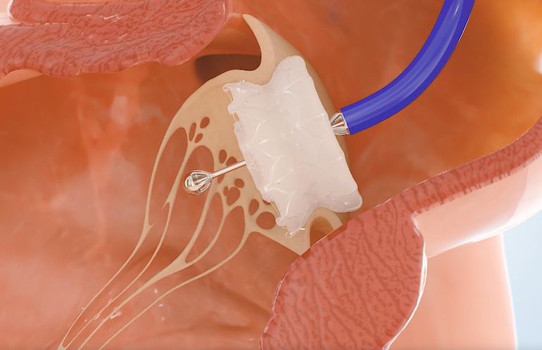 Capstan Medical은 로봇 카테터 승모판 밸브 교체를 완료합니다